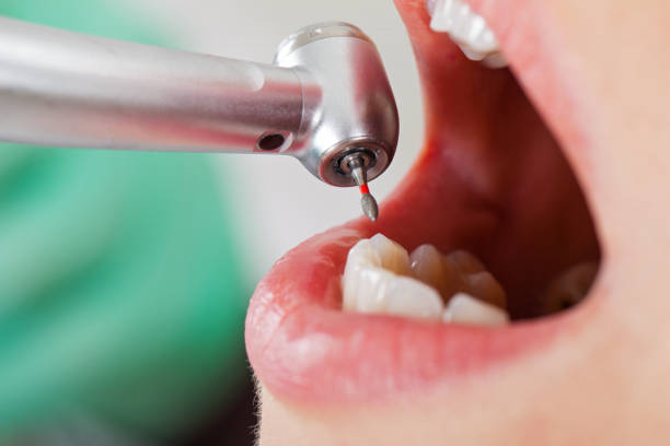 Best Emergency Dental Care for Broken or Chipped Teeth in Cypress Gardens, FL